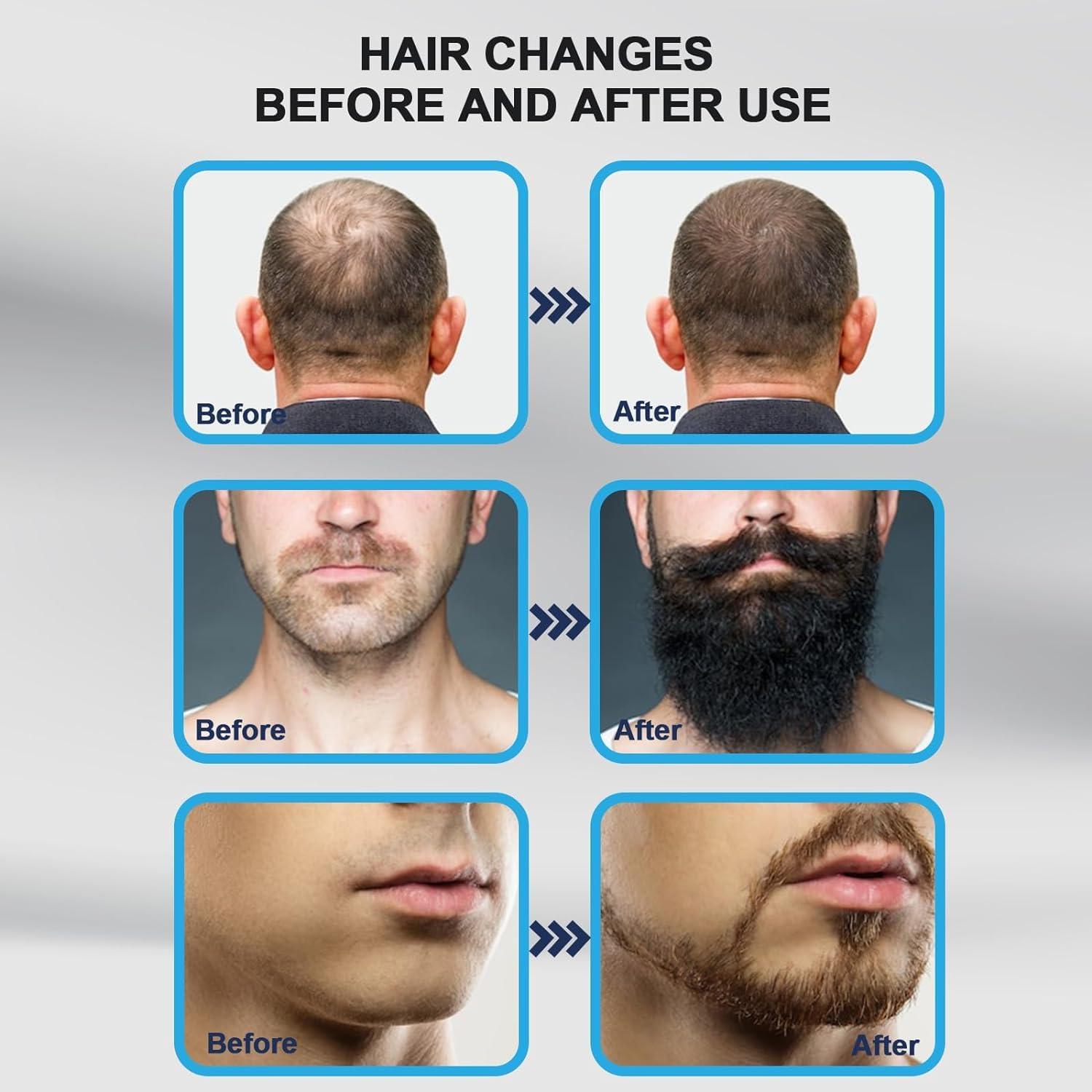 Derma Roller Stamp Titanium Beards Face Hair Growth Micro Needle Skin Care Derma Stamp 0.25mm, 0.5mm, 1.5mm-3.0mm - Image 3